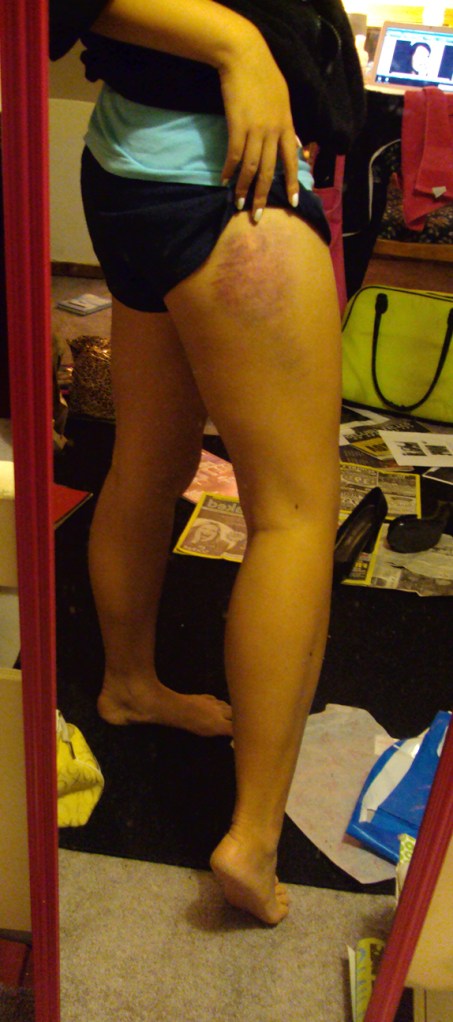 Bruise2 Bruise2